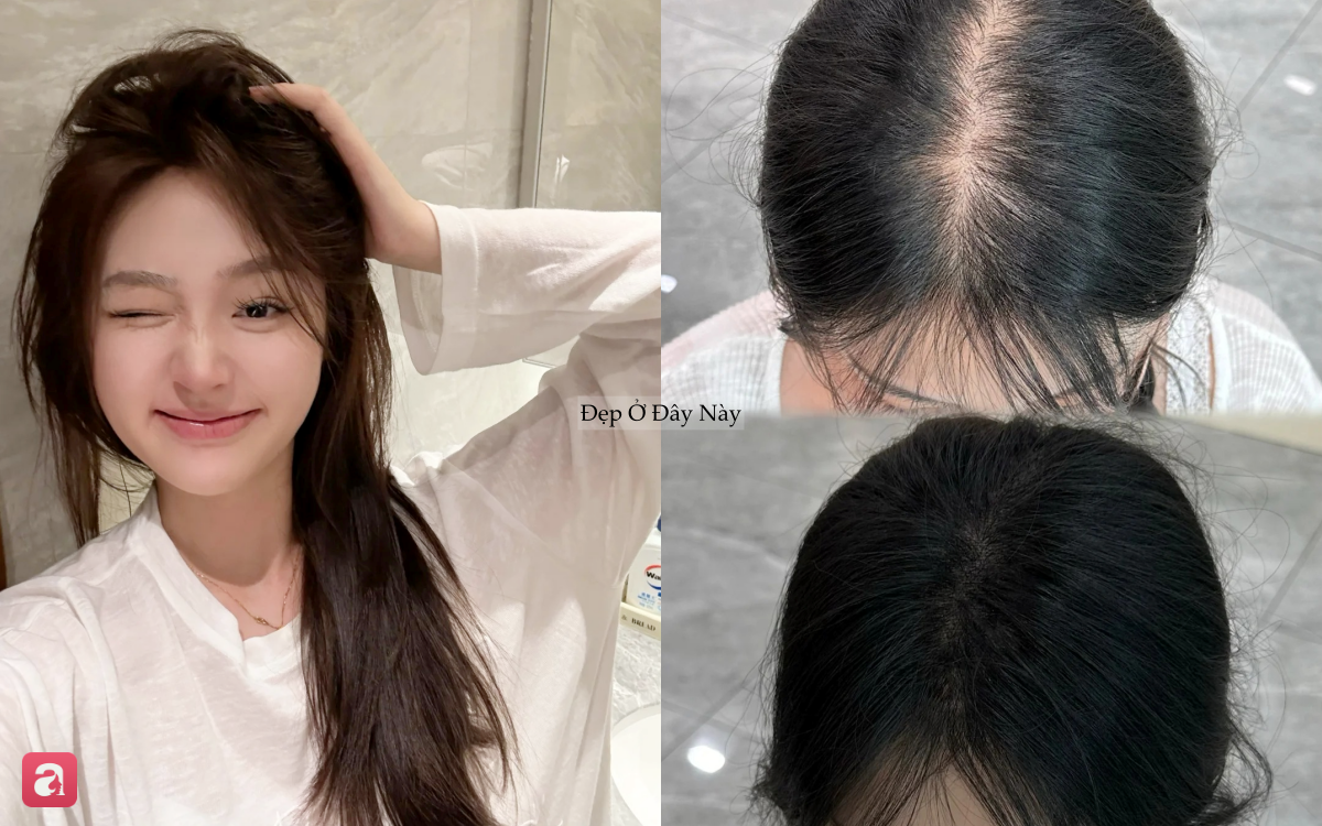 5 dầu gội ngừa rụng tóc