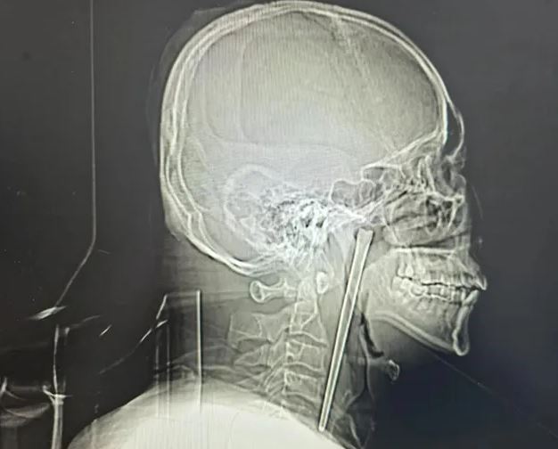 Đau nh&oacute;i mắt tr&aacute;i, người đ&agrave;n &ocirc;ng 50 tuổi sốc nặng khi b&aacute;c sĩ gắp ra thứ 