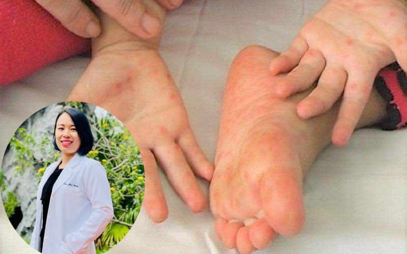 Tổn thương n&atilde;o v&igrave; mắc tay ch&acirc;n miệng - Ảnh 2.