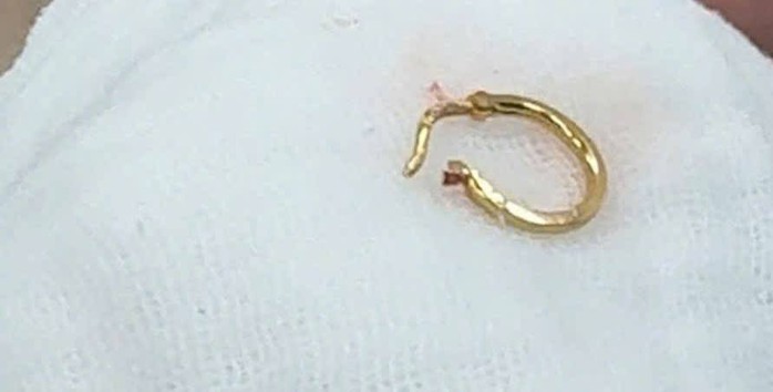 B&eacute; g&aacute;i 8 th&aacute;ng tuổi nhập viện v&igrave; b&ocirc;ng tai trong thực quản cần lưu &yacute; cho mẹ - Ảnh 1.