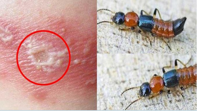 B&aacute;c sĩ BV Bạch Mai cảnh b&aacute;o căn bệnh vi&ecirc;m da do một loại c&ocirc;n tr&ugrave;ng g&acirc;y ra: Cực độc, rất dễ nhầm lẫn với bệnh Zona v&agrave; gặp nhiều v&agrave;o m&ugrave;a h&egrave; - Ảnh 1.