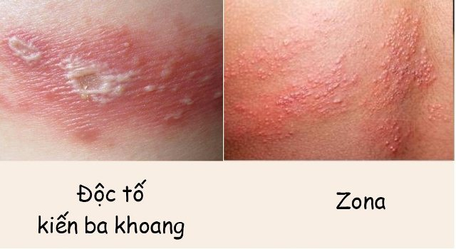 B&aacute;c sĩ BV Bạch Mai cảnh b&aacute;o căn bệnh vi&ecirc;m da do một loại c&ocirc;n tr&ugrave;ng g&acirc;y ra: Cực độc, rất dễ nhầm lẫn với bệnh Zona v&agrave; gặp nhiều v&agrave;o m&ugrave;a h&egrave; - Ảnh 2.