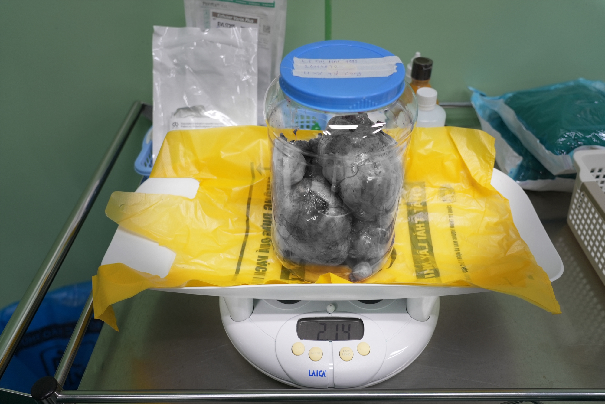 B&oacute;c t&aacute;ch th&agrave;nh c&ocirc;ng 9 khối u xơ tử cung nặng 2,1kg v&agrave; đ&oacute;n b&eacute; trai ch&agrave;o đời - Ảnh 2.