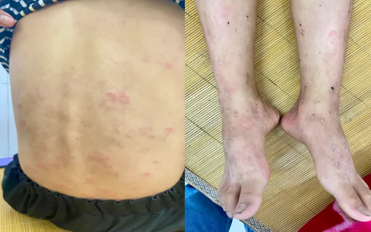 Ban nhiễm khuẩn ở trẻ em: Dấu hiệu v&agrave; c&aacute;ch xử l&yacute; hiệu quả - Ảnh 1.