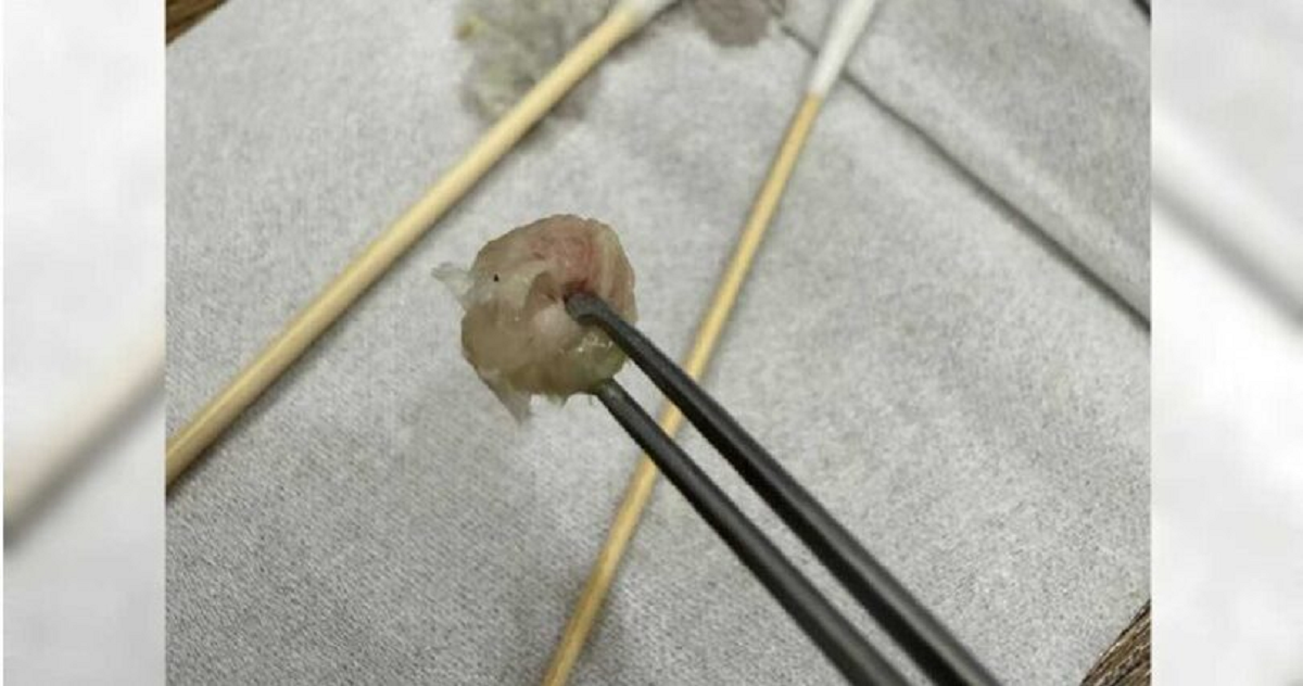 B&eacute; g&aacute;i 6 tuổi nhập viện v&igrave; nh&eacute;t giấy v&agrave;o mũi: C&acirc;u chuyện bất ngờ từ b&aacute;c sĩ - Ảnh 1.