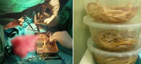 B&eacute; trai 3 tuổi n&ocirc;n ra giun: C&acirc;u chuyện đ&aacute;ng sợ về bệnh giun đũa - Ảnh 1.