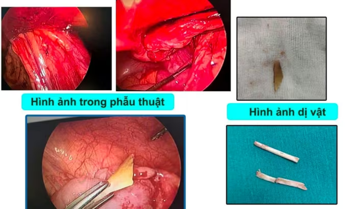 B&eacute; 4 tuổi đau bụng dữ dội, bố mẹ 