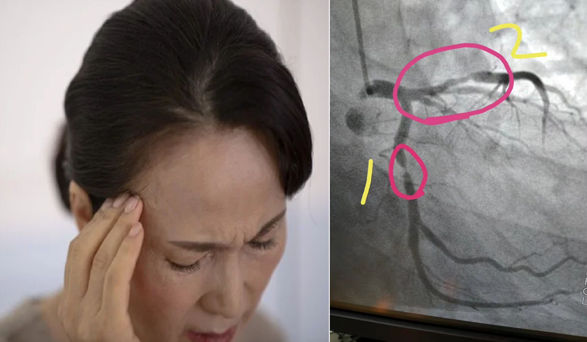 Mảng xơ vữa động mạch của người phụ nữ 53 tuổi biến mất sau 1 năm, b&aacute;c sĩ tấm tắc khen: &ldquo;Duy tr&igrave; 6 th&oacute;i quen thế m&agrave; lại hay&rdquo;- Ảnh 1.