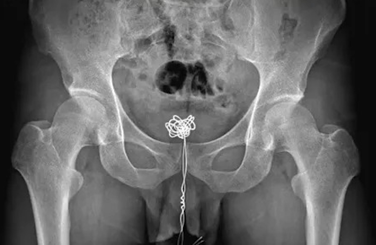 Ch&agrave;ng trai 28 tuổi đau bụng dưới, muốn đi tiểu nhưng kh&ocirc;ng thể đi được, b&aacute;c sĩ kiểm tra ph&aacute;t hiện 1 thứ d&agrave;i 25cm b&ecirc;n trong- Ảnh 2.