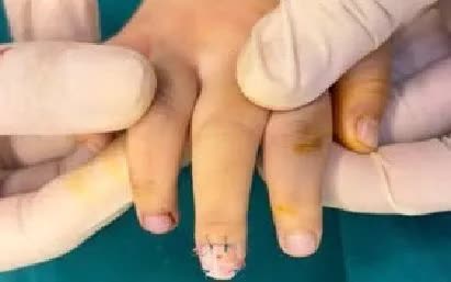 Kẹp cửa g&acirc;y chấn thương đầu ng&oacute;n tay trẻ nhỏ: Cảnh b&aacute;o v&agrave; biện ph&aacute;p an to&agrave;n 2026 - Ảnh 1.