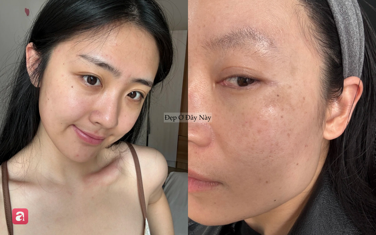 Nơi bị n&aacute;m nhiều nhất tr&ecirc;n khu&ocirc;n mặt h&oacute;a ra lại l&agrave; chỗ dễ 