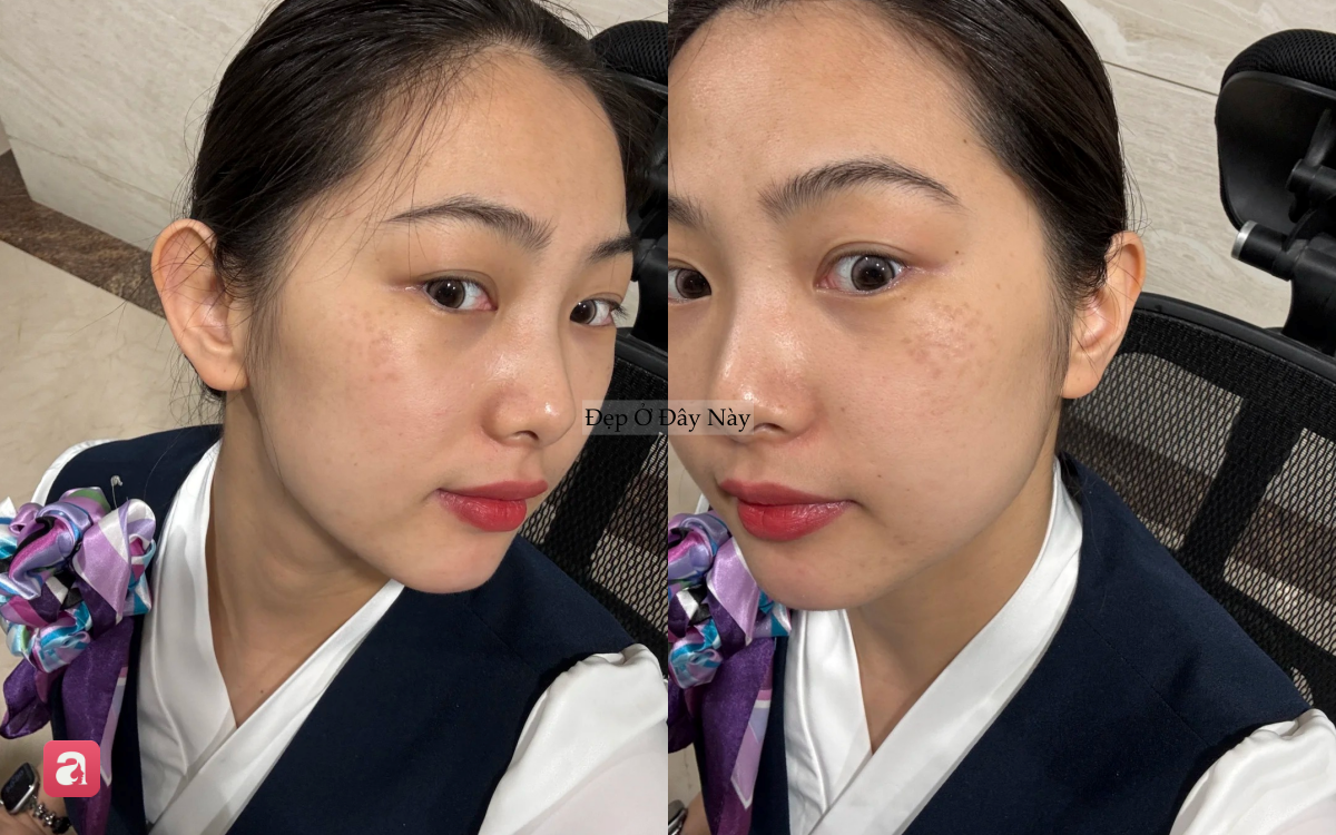 Nơi bị n&aacute;m nhiều nhất tr&ecirc;n khu&ocirc;n mặt h&oacute;a ra lại l&agrave; chỗ dễ 