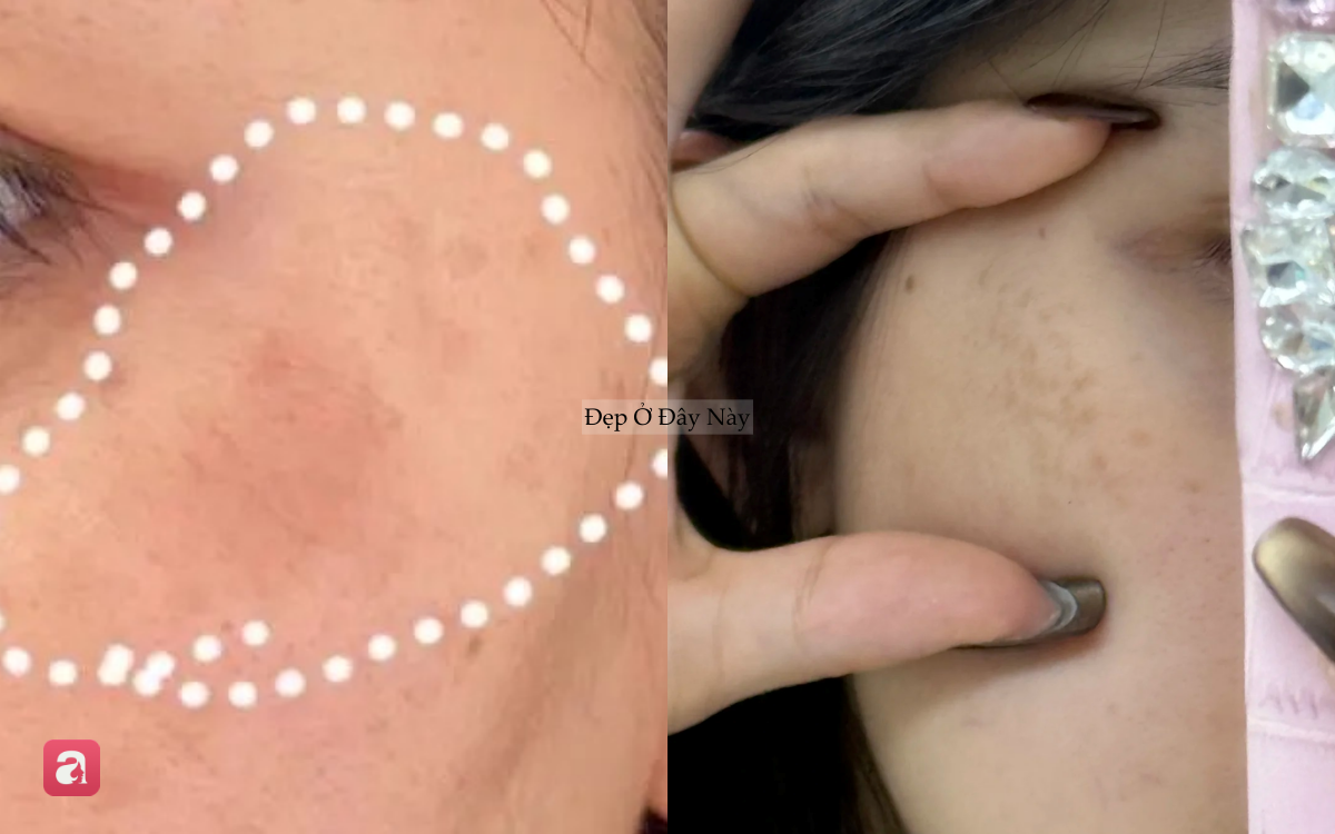 Nơi bị n&aacute;m nhiều nhất tr&ecirc;n khu&ocirc;n mặt h&oacute;a ra lại l&agrave; chỗ dễ 