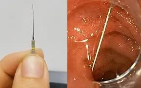 Nguy hiểm khi trẻ nuốt kim lấy tủy răng trong điều trị nha khoa - Ảnh 1.