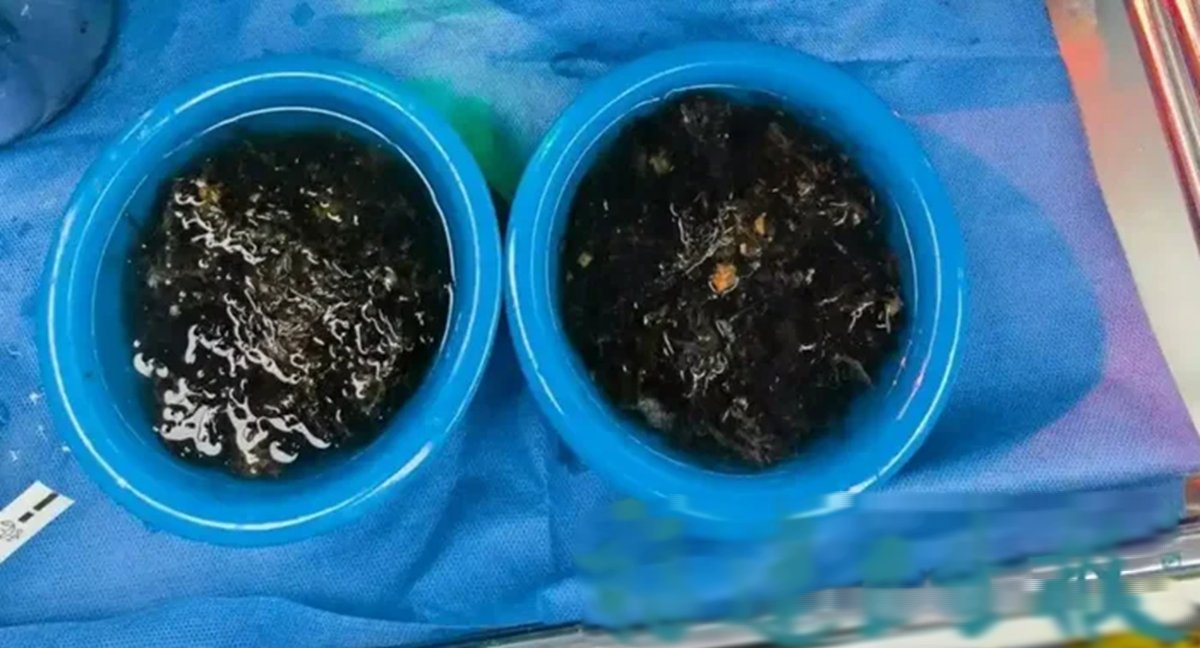 B&eacute; g&aacute;i 10 tuổi bị đau bụng do b&uacute;i t&oacute;c khổng lồ trong dạ d&agrave;y - Ảnh 2.