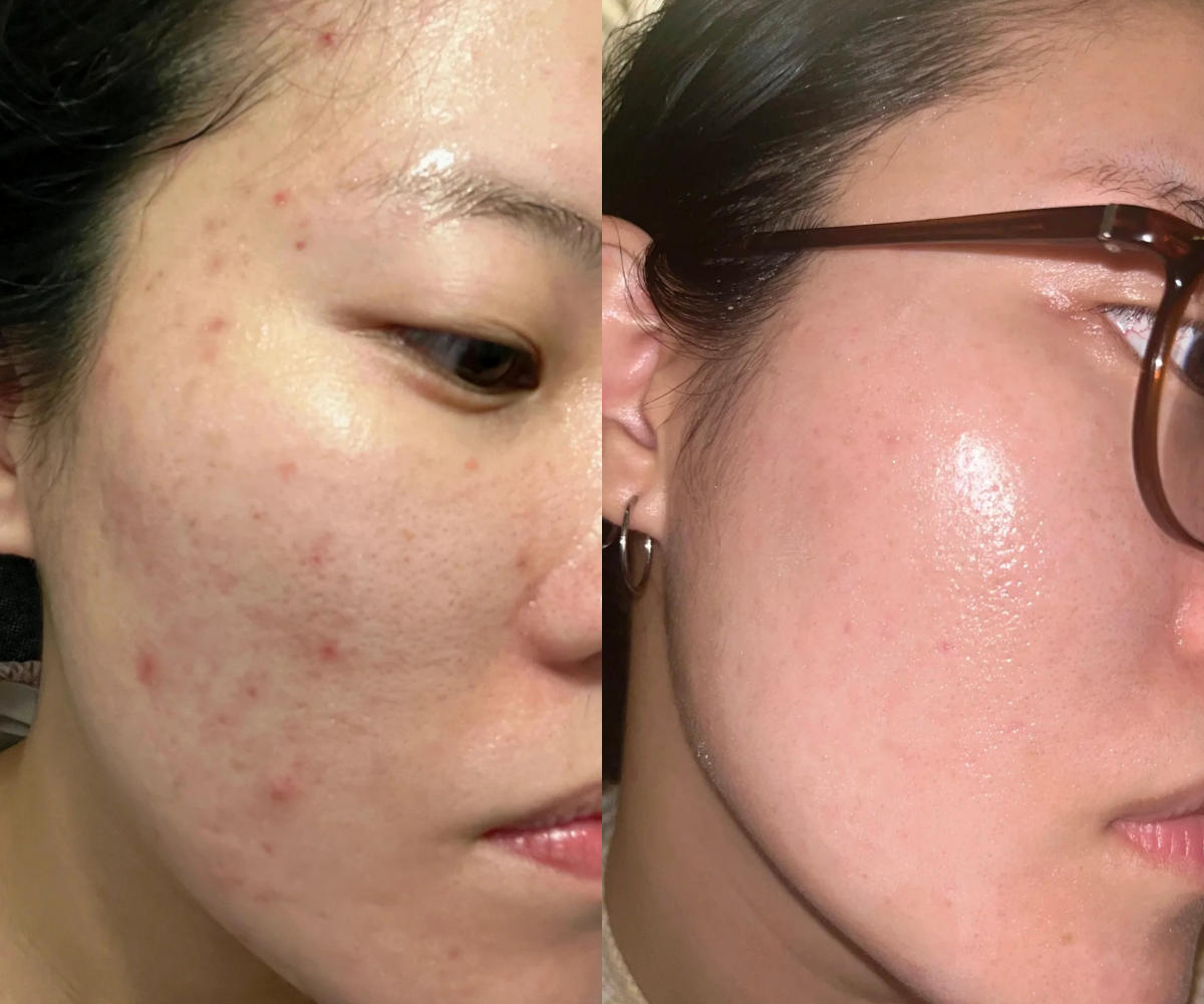 Da mẩn đỏ, lỗ chân lông to cải thiện rõ rệt nhờ routine skincare chỉ vỏn vẹn 4 bước - Ảnh 1.
