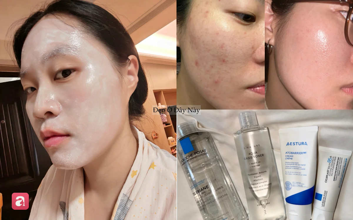 Da mẩn đỏ, lỗ chân lông to cải thiện rõ rệt nhờ routine skincare chỉ vỏn vẹn 4 bước - Ảnh 2.
