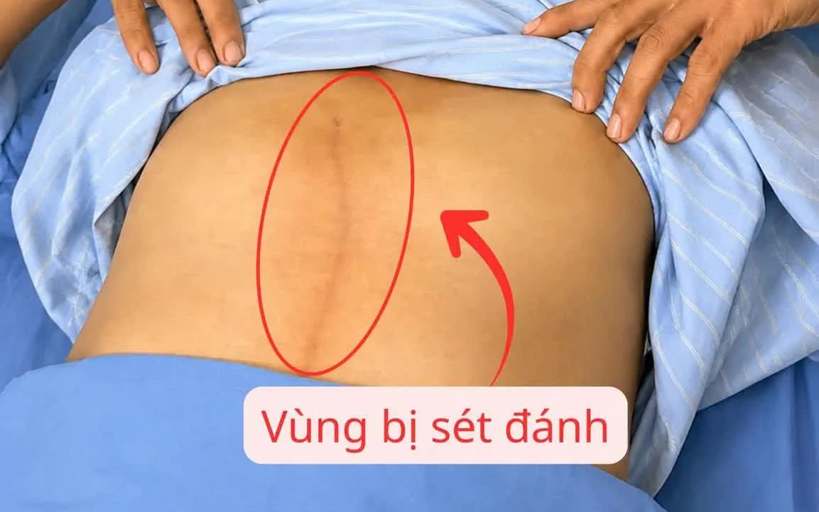 Tho&aacute;t nguy kịch sau khi bị s&eacute;t đ&aacute;nh l&uacute;c đang lao động - Ảnh 1.