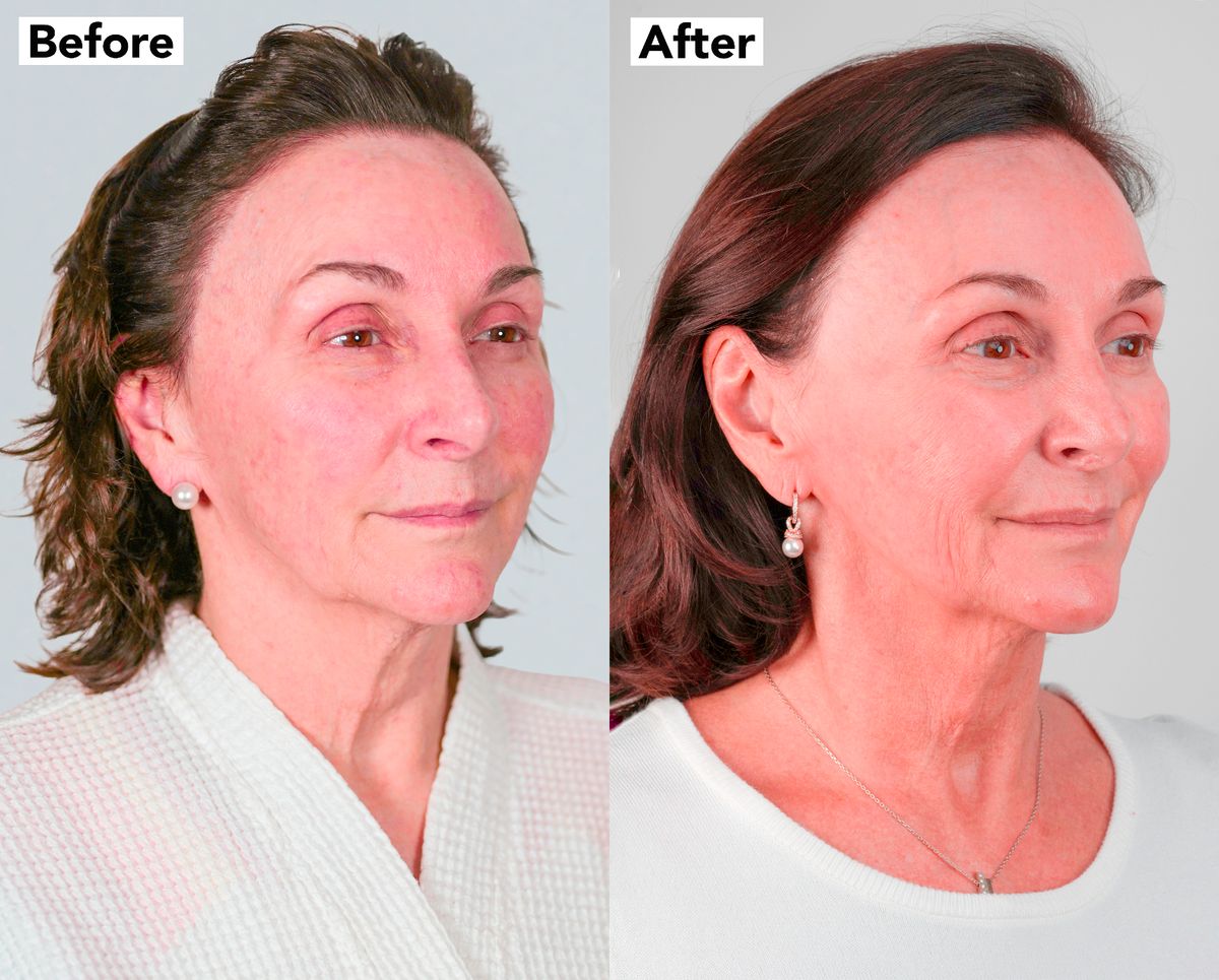 Không tiêm Botox, không phẫu thuật, nữ nghệ sĩ 67 tuổi khiến nhiều người ngỡ chỉ ngoài 40 nhờ một công nghệ trẻ hóa không cần dao kéo - Ảnh 5.