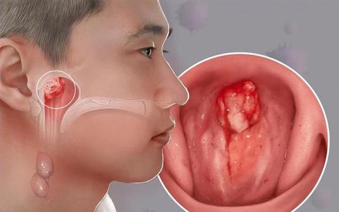 Bé trai 15 tháng tuổi nguy kịch sau khi bị ong vò vẽ đốt 60 nốt - Ảnh 2.