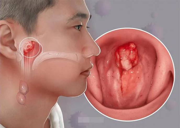 Bé trai 14 tuổi chiến thắng ung thư vòm mũi họng giai đoạn tiến triển: Bác sĩ cảnh báo những dấu hiệu cha mẹ rất dễ bỏ qua - Ảnh 2.