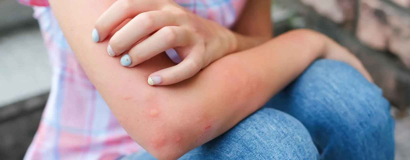Một phụ nữ bị hạ huyết &aacute;p, nổi mẩn khắp người sau khi ăn c&aacute; nướng, nội soi ph&aacute;t hiện nguy&ecirc;n nh&acirc;n g&acirc;y sốc - Ảnh 1.