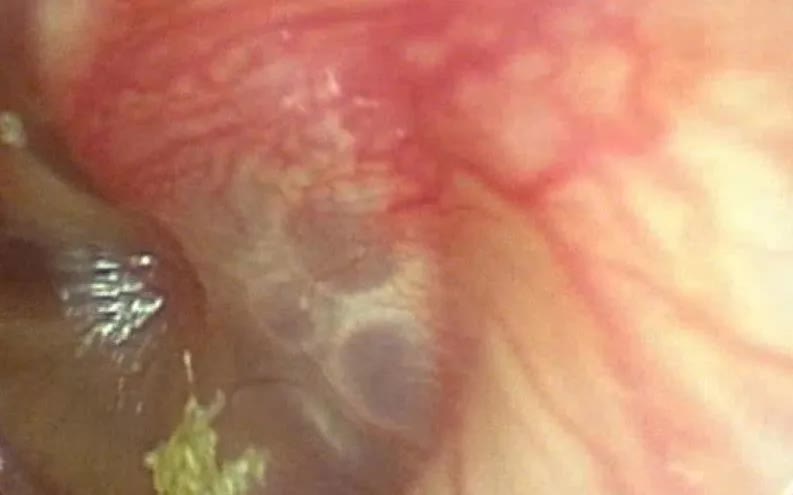 Đau tai sau bơi v&agrave; tắm biển ở trẻ: Cảnh b&aacute;o vi&ecirc;m tai giữa cần lưu &yacute; - Ảnh 1.