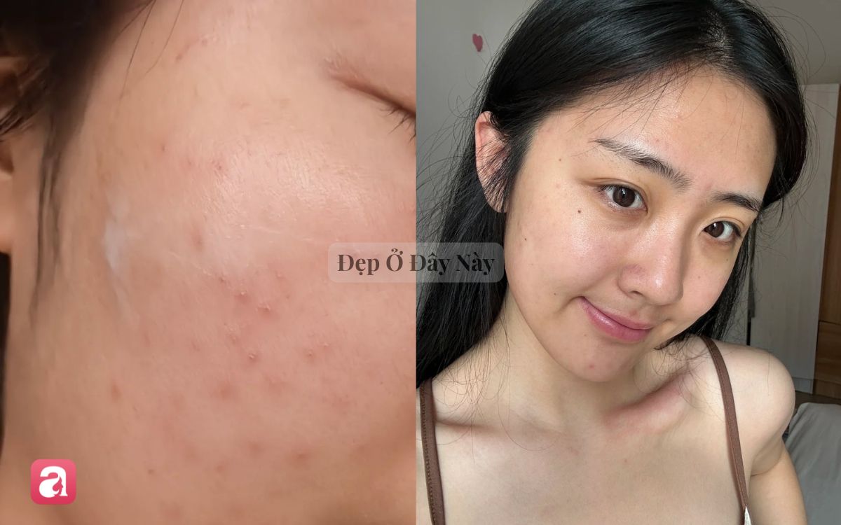 V&igrave; sao dưỡng da qu&aacute; nhiều lại c&oacute; thể khiến l&agrave;n da ng&agrave;y c&agrave;ng xấu đi? - Ảnh 1.