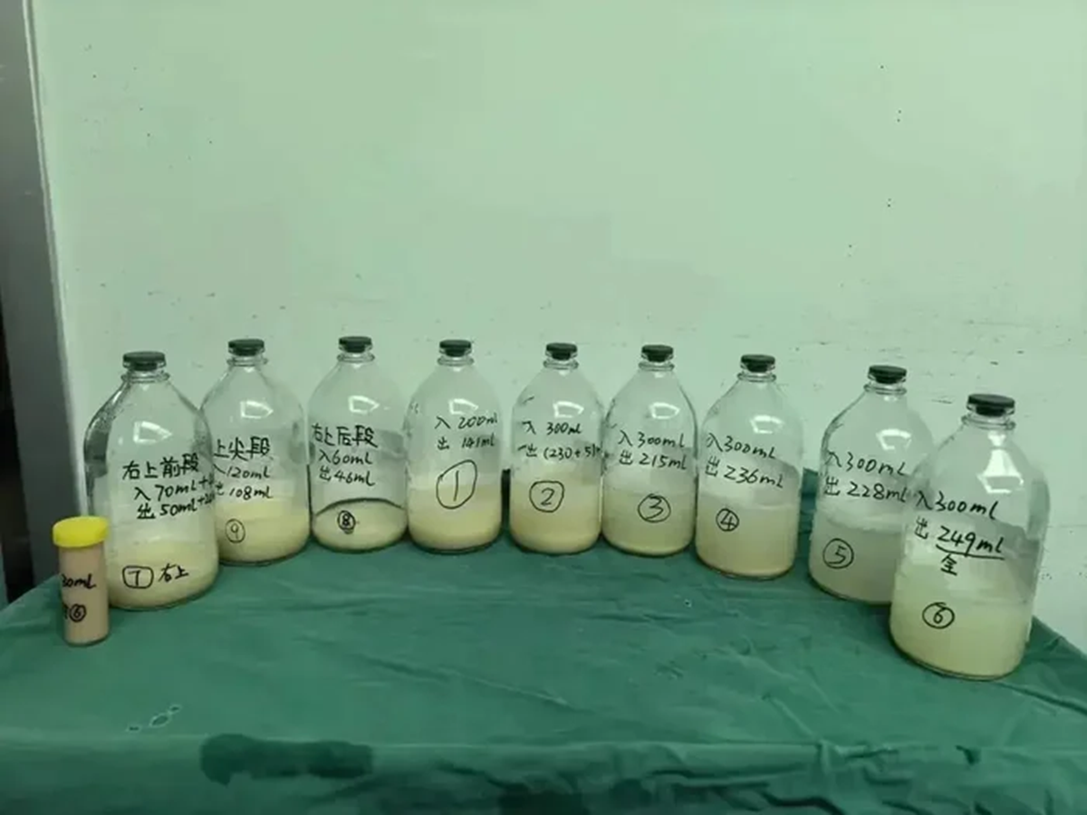 B&eacute; g&aacute;i 6 tuổi ho khan , b&aacute;c sĩ ph&aacute;t hiện nguy&ecirc;n nh&acirc;n hiếm gặp trong phổi - Ảnh 1.
