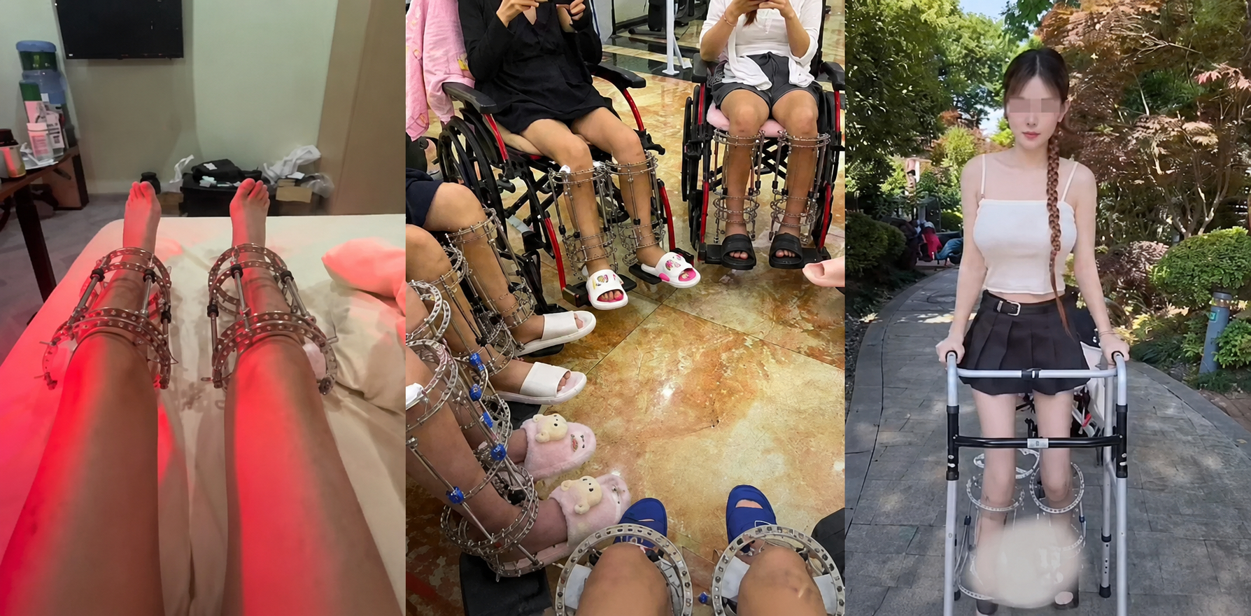 Điều tra chợ đen phẫu thuật k&eacute;o d&agrave;i ch&acirc;n tại Trung Quốc v&agrave; những hệ lụy nhức nhối - Ảnh 1.