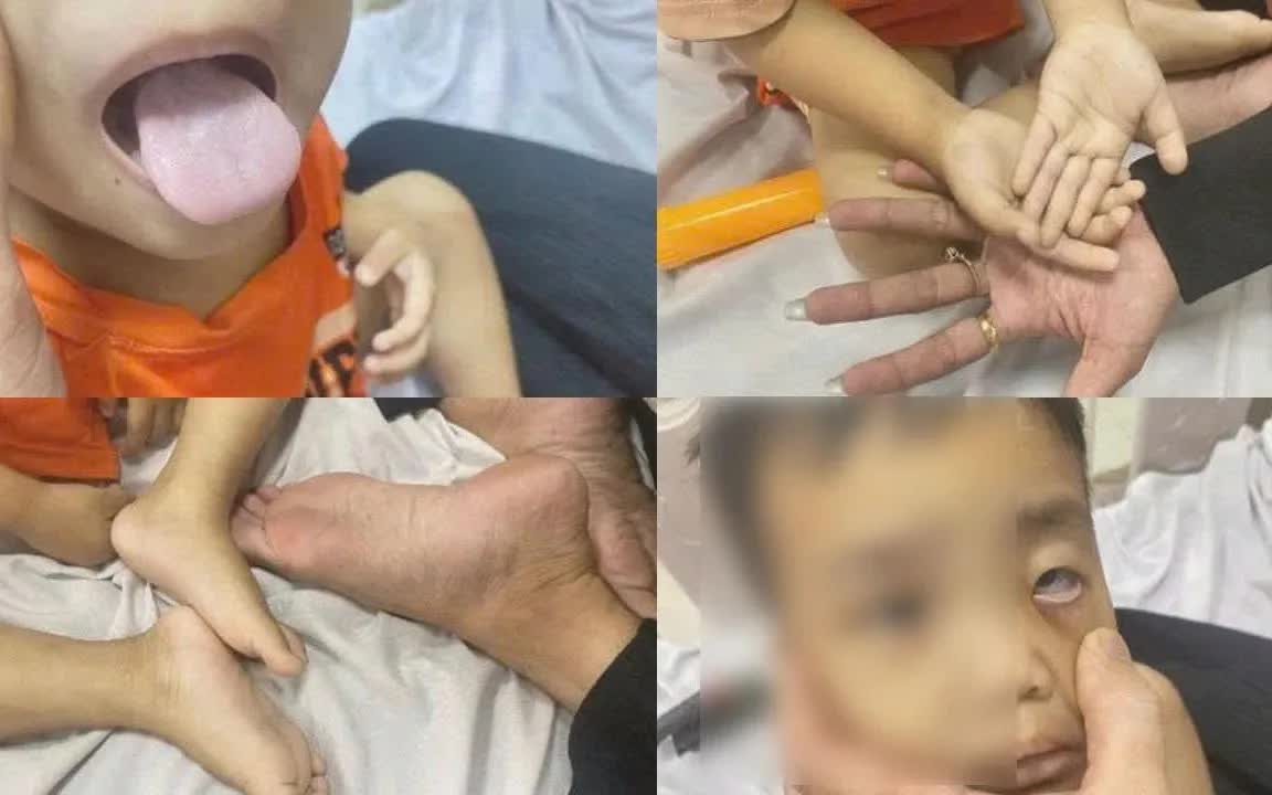 Trẻ thiếu m&aacute;u nặng v&igrave; chỉ uống sữa, biếng ăn k&eacute;o d&agrave;i - Ảnh 1.