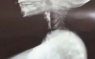 B&eacute; trai nuốt nghẹn 3 năm v&igrave; bệnh hiếm gặp - Ảnh 1.