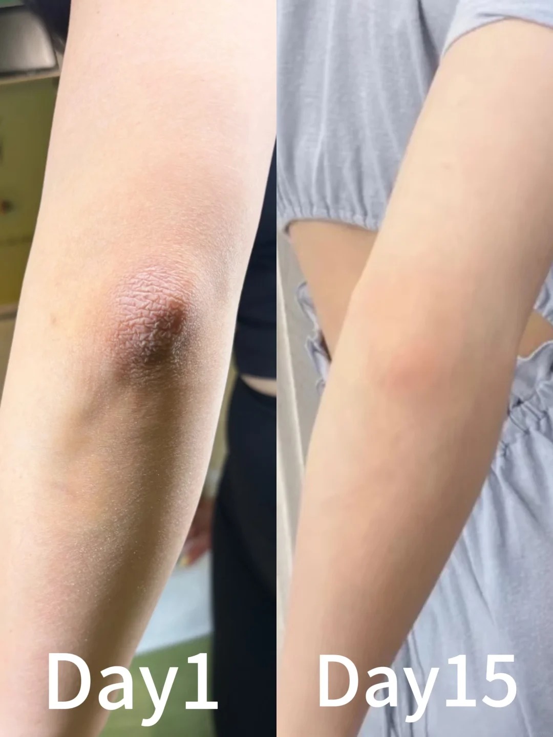 Thử &ldquo;giải cứu&rdquo; khuỷu tay th&acirc;m trong 1 tuần với 4 bước: C&oacute; một bước t&ocirc;i khuy&ecirc;n kh&ocirc;ng n&ecirc;n t&ugrave;y tiện l&agrave;m theo - Ảnh 1.