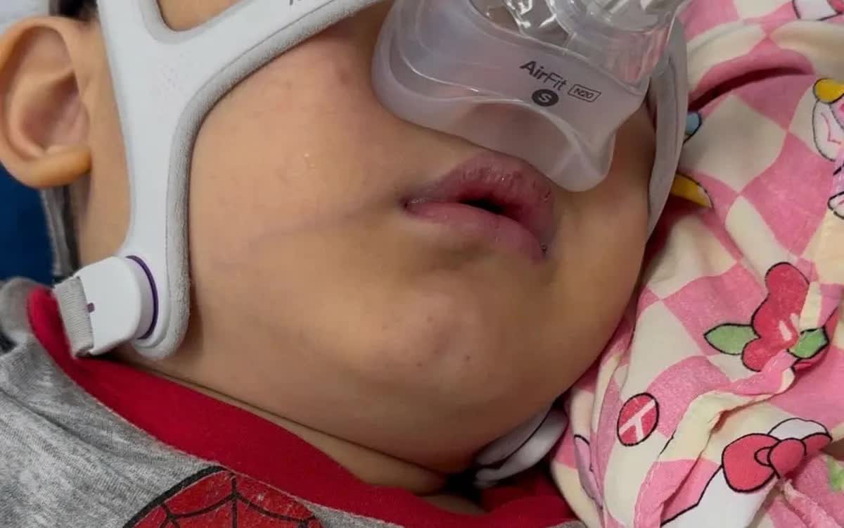 T&iacute;m t&aacute;i khi ngủ, b&eacute; trai 4 tuổi ph&aacute;t hiện giảm th&ocirc;ng kh&iacute; do b&eacute;o ph&igrave; - Ảnh 1.