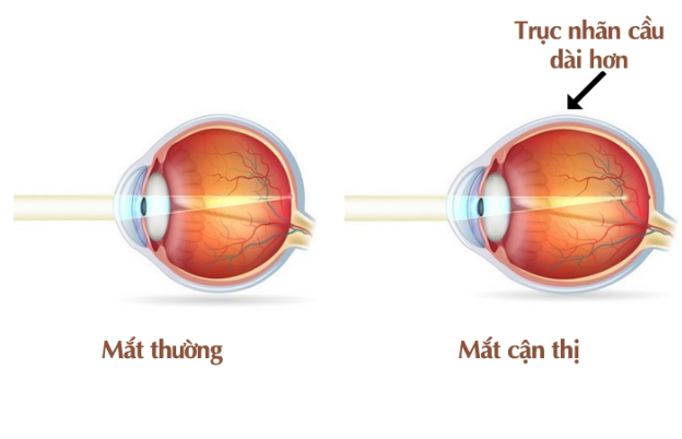 Độ cận tăng kh&ocirc;ng chỉ khiến trẻ thay k&iacute;nh nhiều hơn: Những nguy cơ từ cận thị m&agrave; cha mẹ chưa biết - Ảnh 1.