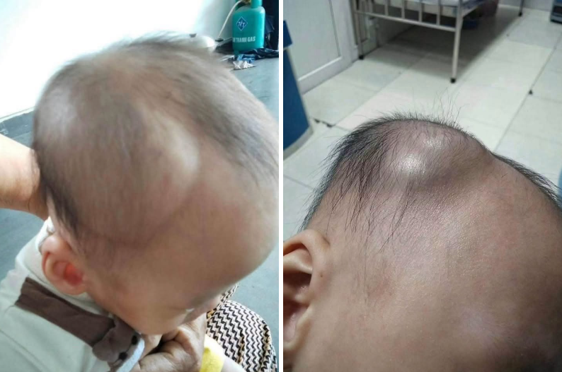 1 mẹ bỉm chia sẻ diễn biến &acirc;m thầm nhưng nguy hiểm sau c&uacute; ng&atilde; của con: Đừng chủ quan kể cả khi b&eacute; c&oacute; vẻ vẫn b&igrave;nh thường- Ảnh 1.