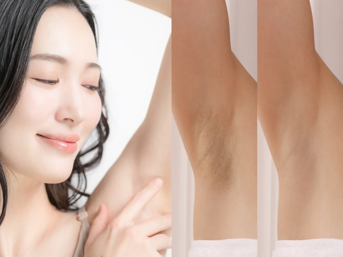 Tự ti không dám mặc áo hai dây, rõ ràng ngày nào cũng tắm sạch, sao "vùng cánh" vẫn thâm sạm: Bác sĩ tiết lộ sự thật và cách làm trắng - Ảnh 1.