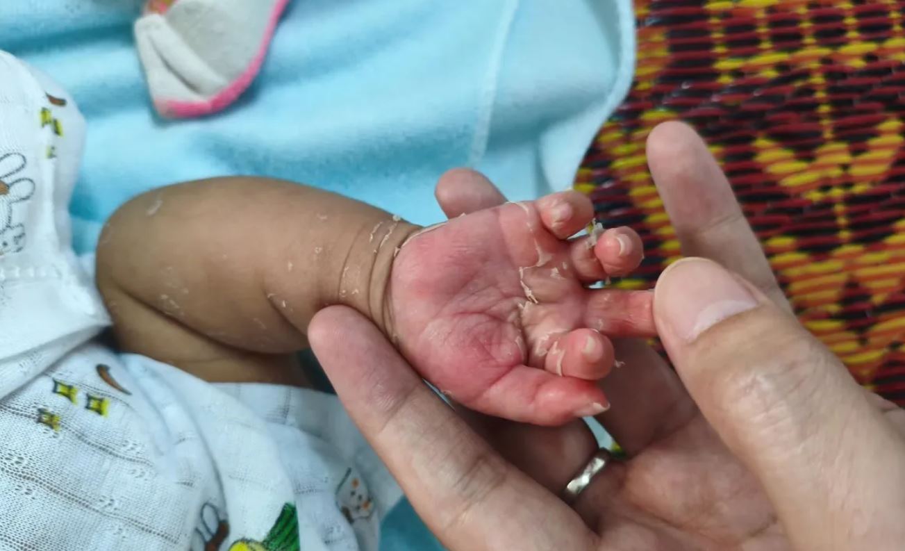 Dấu hiệu lạ trên da bé 2 tháng tuổi: Cảnh báo giang mai bẩm sinh - Ảnh 1. Dấu hiệu lạ trên da bé 2 tháng tuổi: Cảnh báo giang mai bẩm sinh - Ảnh 1.
