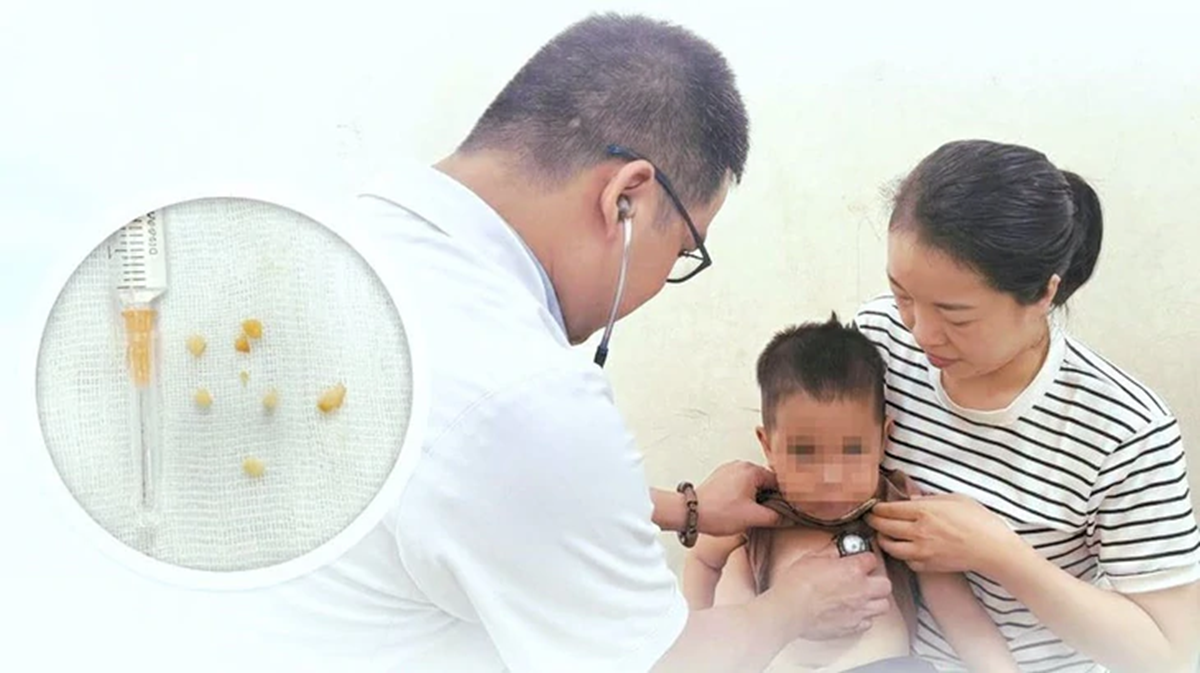 Bé 2 tuổi tím tái Sau khi hóc hạt lạc - cảnh báo nguy hiểm cho sức khỏe trẻ nhỏ - Ảnh 1. Bé 2 tuổi tím tái Sau khi hóc hạt lạc - cảnh báo nguy hiểm cho sức khỏe trẻ nhỏ - Ảnh 1.