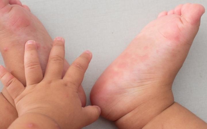 Chủ động ph&ograve;ng bệnh tay ch&acirc;n miệng - Ảnh 2.