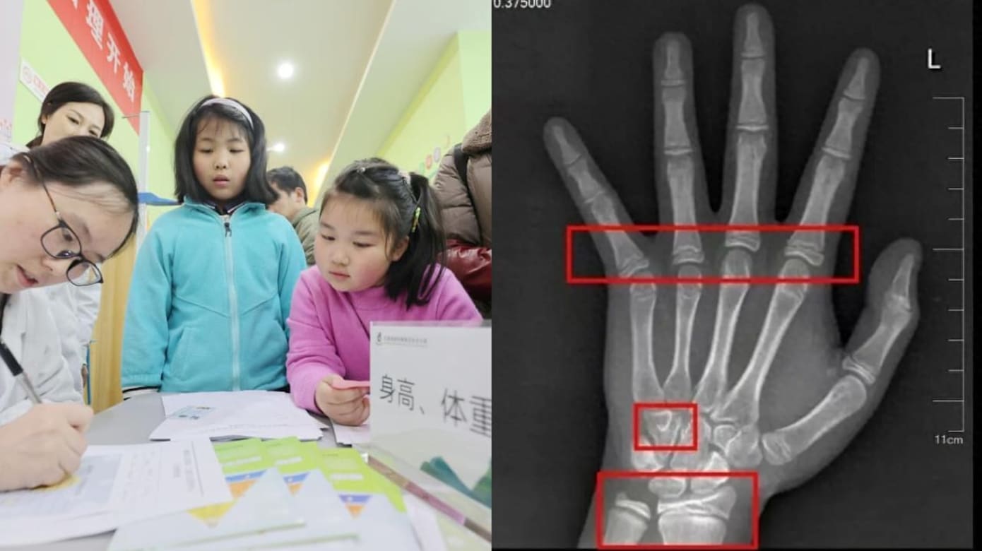 Bé gái 9 tuổi dậy thì sớm, bác sĩ phát hiện một thói quen nhiều gia đình vẫn làm mỗi đêm - Ảnh 2.
