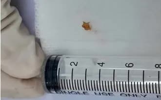 Mẩu xương lươn mắc phế quản g&acirc;y ho k&eacute;o d&agrave;i ở trẻ em - Ảnh 1.