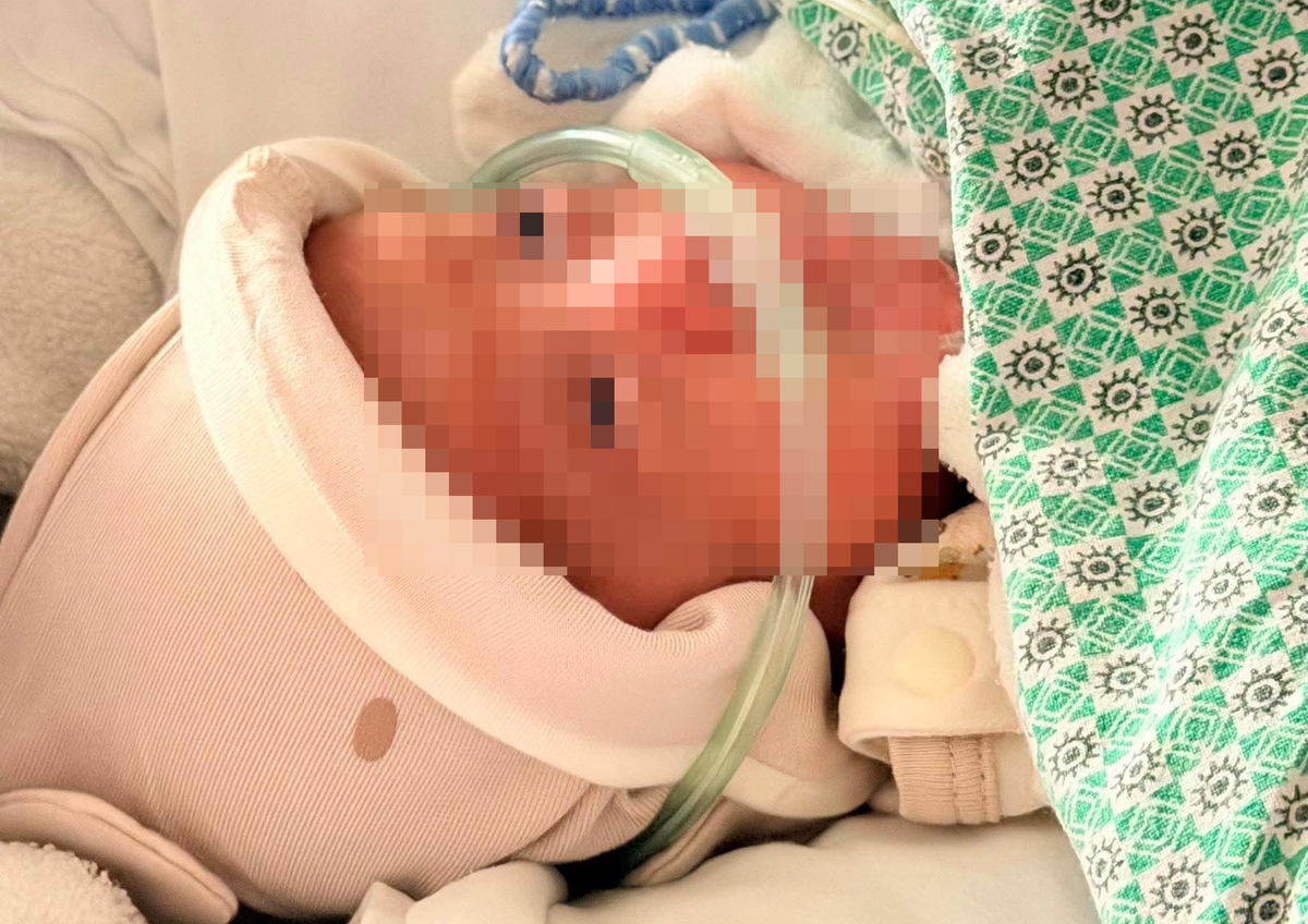 Kỳ t&iacute;ch: Em b&eacute; sinh non 330 gram vượt 