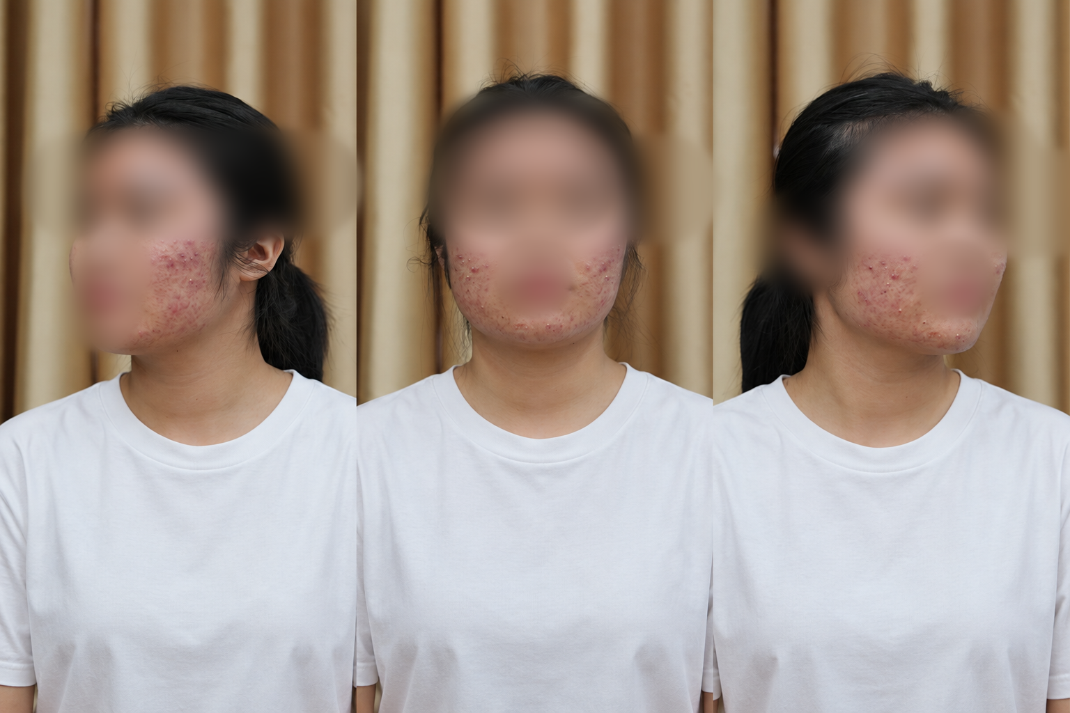 L&agrave;m đẹp cấp tốc m&ugrave;a tựu trường, nhiều nữ sinh mặt sưng như ong đốt - Ảnh 1.