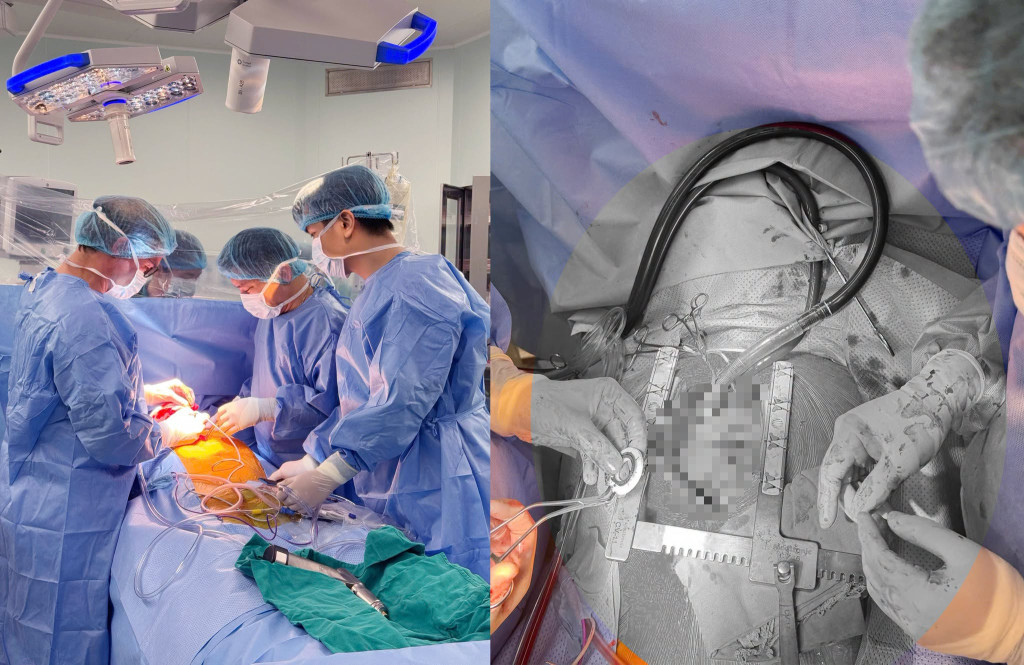 Cấy gh&eacute;p tr&aacute;i tim cơ học CorHeart 6 Lần đầu ti&ecirc;n tại Việt Nam cho bệnh nh&acirc;n suy tim - Ảnh 1.
