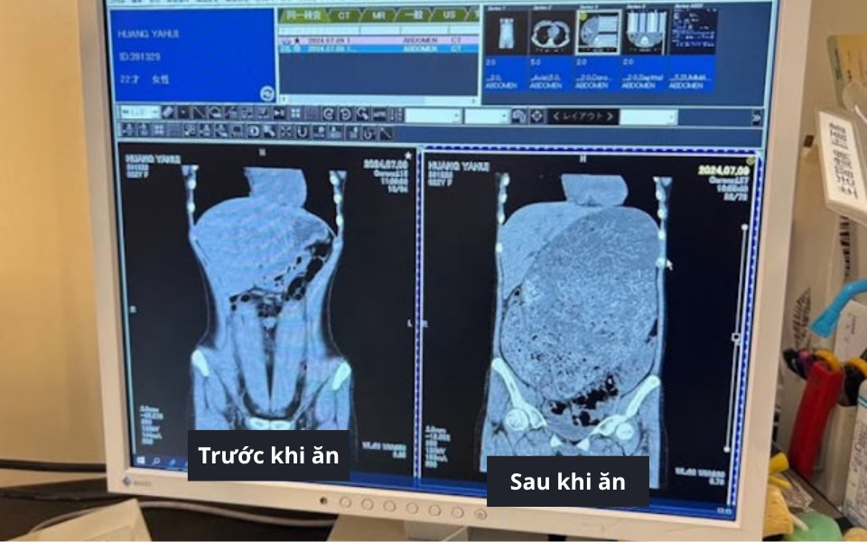 Ảnh chụp CT dạ dày phình to gây sốc của Tiểu Huệ khiến nhiều người lo ngại sức khỏe - Ảnh 1. Ảnh chụp CT dạ dày phình to gây sốc của Tiểu Huệ khiến nhiều người lo ngại sức khỏe - Ảnh 1.