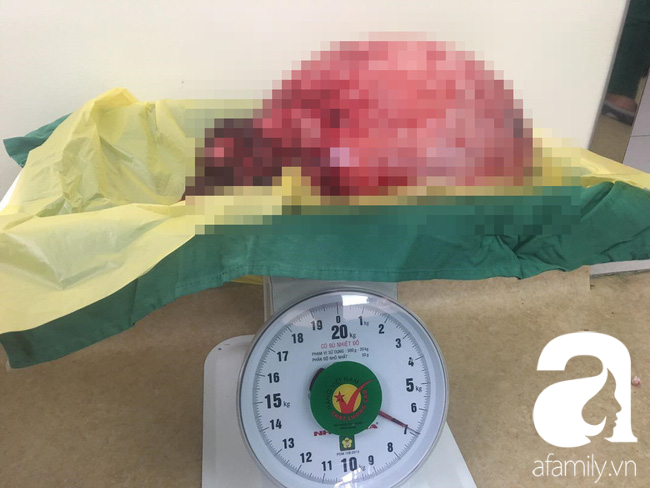 Cứu sống một phụ nữ mang khối u trong tử cung nặng đến…12kg - Ảnh 3.