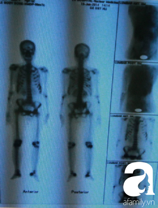 Người phụ nữ bị U gây bệnh nhuyễn xương đầu tiên tại Việt Nam được cứu chữa ngoạn mục - Ảnh 2.