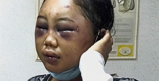 Nữ giúp việc 19 tuổi người Indonesia bị bà chủ Malaysia bạo hành dã man - Ảnh 1.