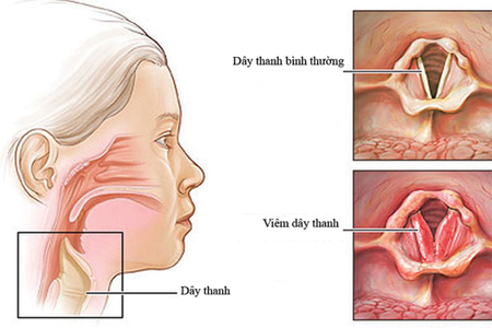 Xơ dây thanh quản - căn bệnh có thể Thanh Vân Hugo và ca sĩ Thu Phượng bị câm nguy hiểm thế nào? - Ảnh 4.